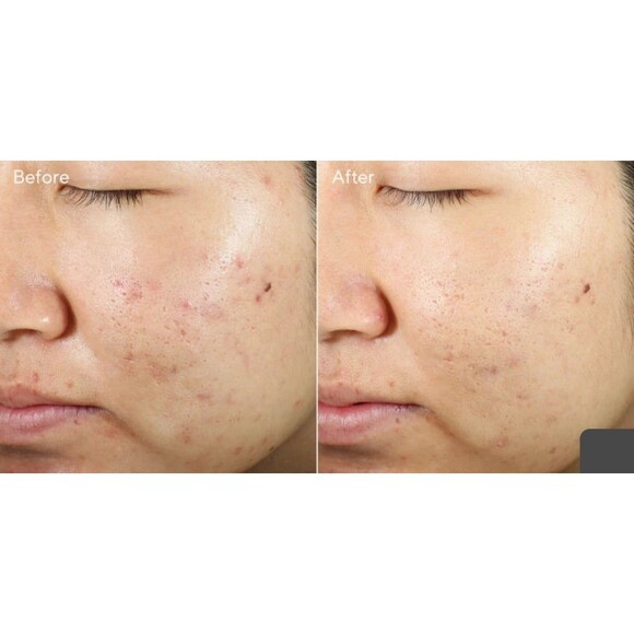 Murad InvisiScar Resurfacing Treatment FULL SIZE - Picture 10 of 12
